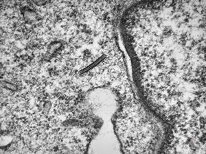 M, 1y. | histiocytosis X (eosinophilic granuloma) - Birbeck body M, 1y. | histiocytosis X (eosinophilic granuloma) - Birbeck body